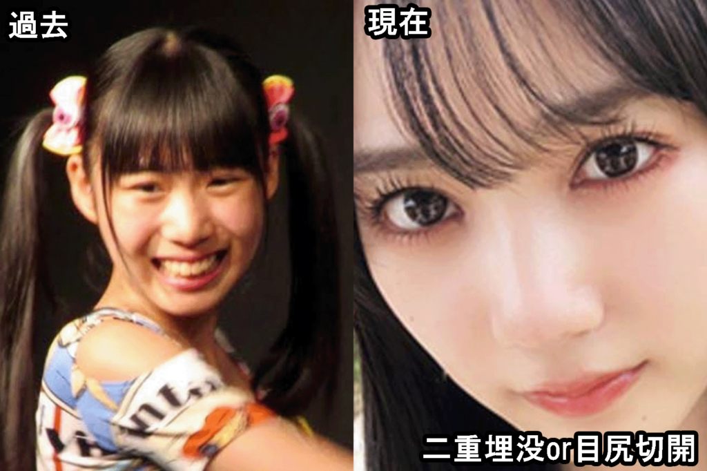 横野すみれ整形疑惑