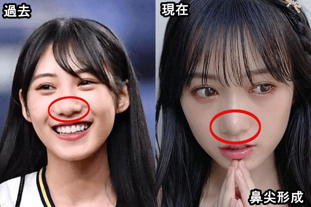横野すみれ整形疑惑