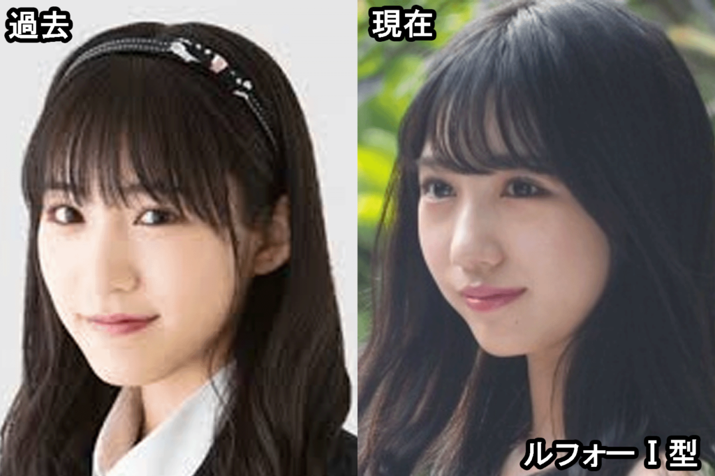 横野すみれ整形疑惑