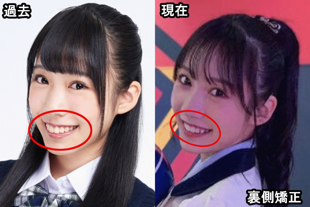 横野すみれ整形疑惑