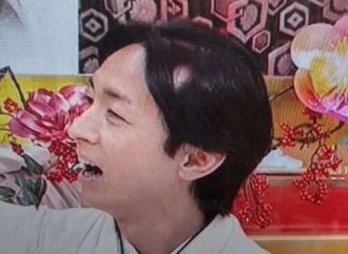 矢部浩之円形脱毛症