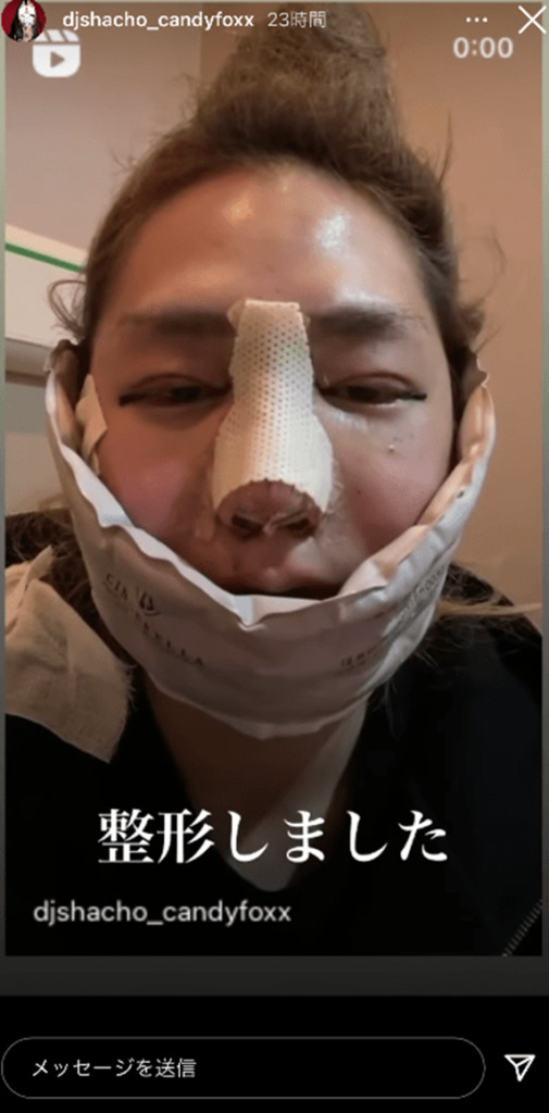 DJ社長鼻整形