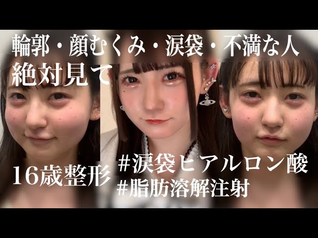 こはくぶちょー整形②